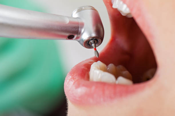 Best Urgent Care for Lost Fillings or Crowns in East Moriches, NY
